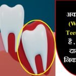 अकल दाढ़ (Wisdom Teeth) क्या है, और ये कब निकलती है?
