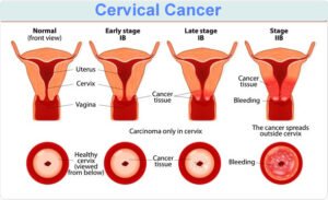 सर्वाइकल कैंसर
